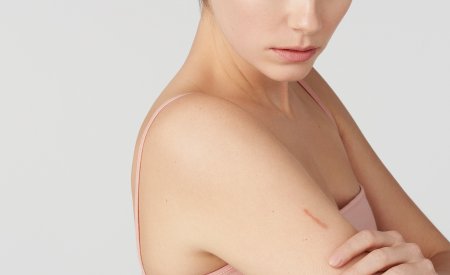 Piel Danada O Irritada Bioderma