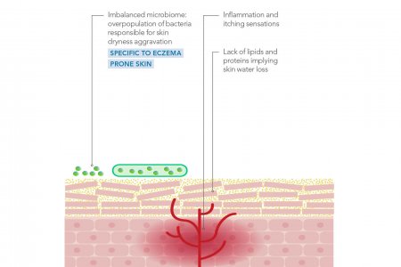 Graphical representation of the behaviour of skin suffering from atopic dermatitis.