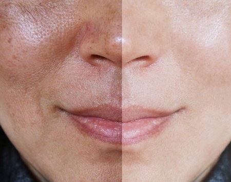 mujer antes y después de usar la crema despigmentante de BIODERMA