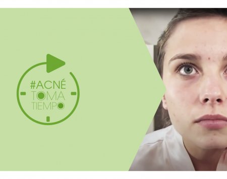 Portada-video-YT-acné