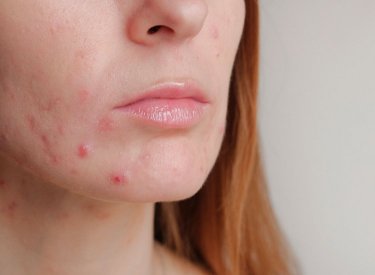 Acne en la cara de una mujer