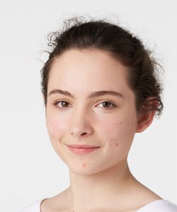 BIODERMA - piel con acné en adolescentes